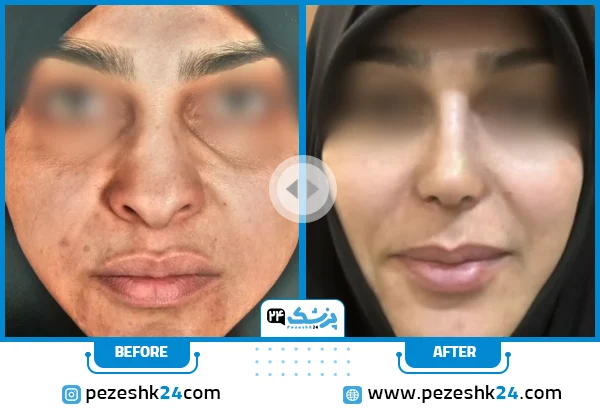 قبل و بعد عمل زیبایی بینی دکتر آلانی قم