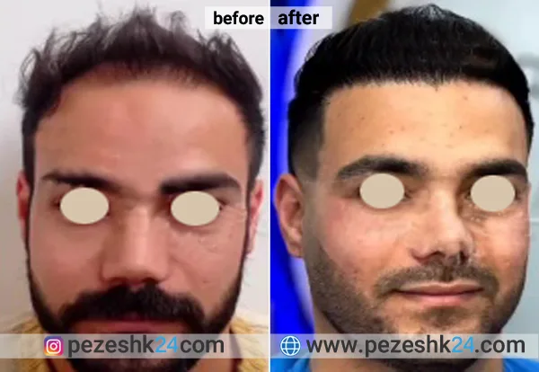 نمونه کاشت مو در کلینیک دوستی کرمانشاه 2