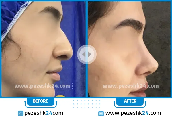 قبل و بعد جراحی بینی دکتر ایرج وکیلی مشهد