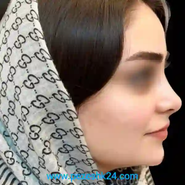 نمونه عمل بینی دکتر لیلا اسدپور شیراز