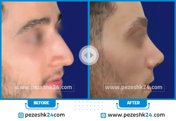 قبل و بعد عمل بینی دکتر شیرین گل محمدی