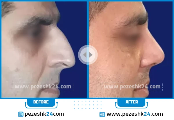 قبل و بعد عمل بینی دکتر گل محمدی