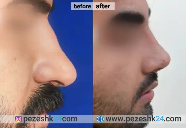 قبل و بعد جراحی بینی دکتر سمانه صوفی کرج