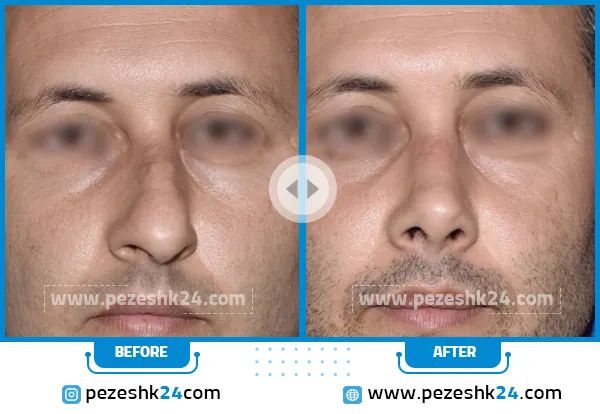 قبل و بعد عمل بینی دکتر ادهم