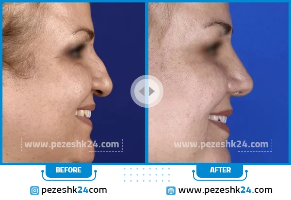 قبل و بعد رینوپلاستی دکتر ادهم
