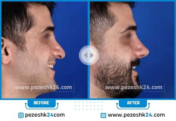قبل و بعد جراحی بینی دکتر ادهم رشت