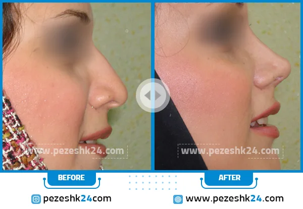 قبل و بعد عمل بینی دکتر ابراهیمی نژاد رشت