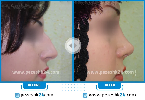 قبل و بعد عمل بینی دکتر فروغ ابراهیمی نژاد