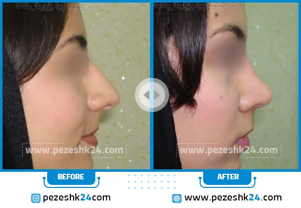 قبل و بعد جراحی بینی دکتر ابراهیمی نژاد