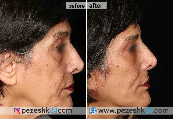 نمونه جراحی لیفت صورت دکتر ابدالی در اصفهان