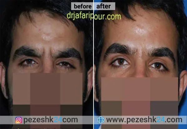 نمونه جراحی لیفت صورت دکتر جعفری پور در اصفهان