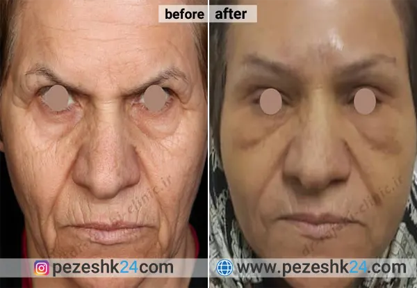 نمونه جراحی لیفت صورت دکتر رجبی در اصفهان