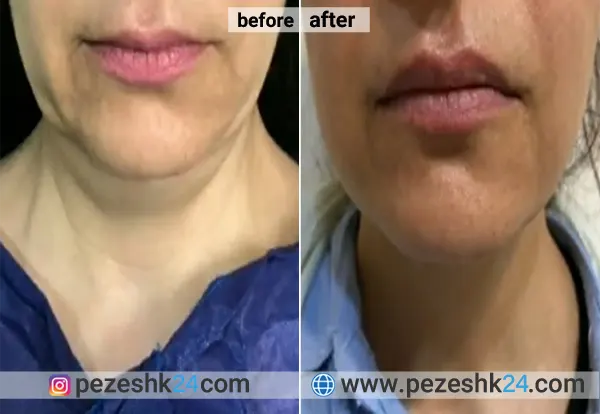 نمونه کار لیپو دکتر ابدالی در اصفهان 1