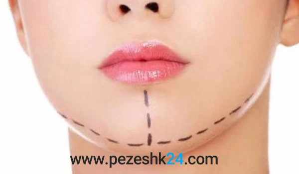 عمل جراحی چانه در مشهد