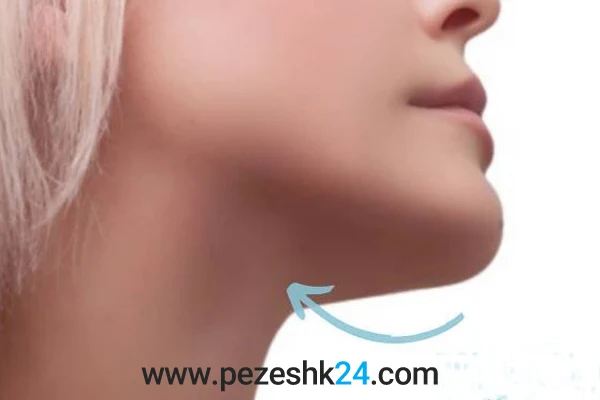 عمل جراحی چانه در مشهد