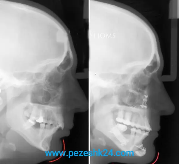 عکس از جراحی پروتز چانه مشهد