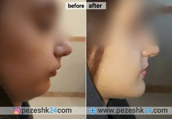 قبل و بعد از جراحی چانه مشهد
