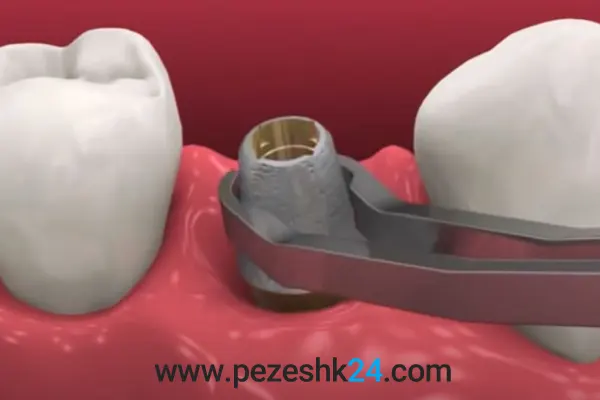 قرار دادن پایه ایمپلنت دندان در رشت