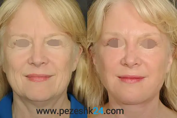 عمل لیفت صورت شیراز