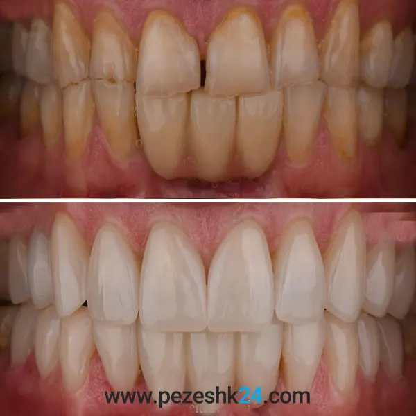 نمونه کار لمینت دندان دکتر کریمی 4