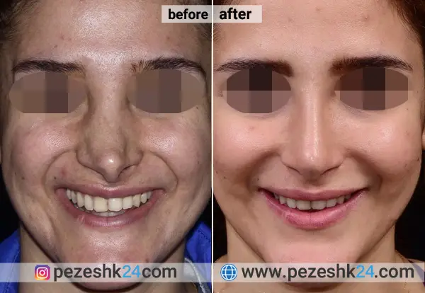عکس قبل و بعد عمل بینی ترمیمی دکتر دریانی