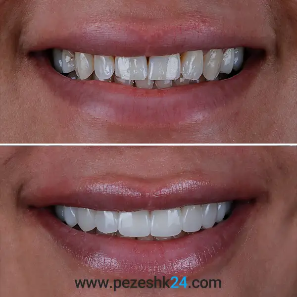 عکس قبل و بعد کامپوزیت دندان دکتر فلاح 3