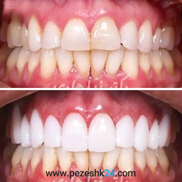 عکس قبل و بعد کامپوزیت دندان دکتر هادی 1