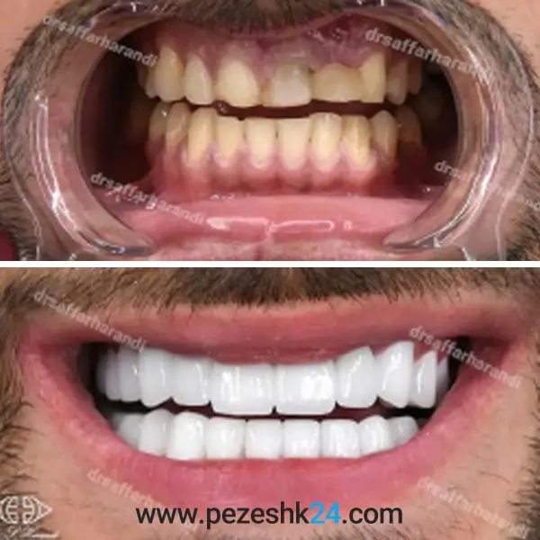 عکس قبل و بعد کامپوزیت دندان دکتر صفار هرندی 2