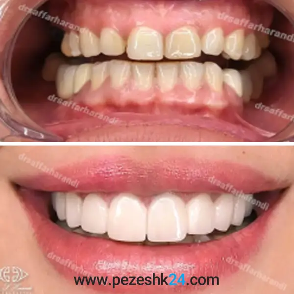 عکس قبل و بعد کامپوزیت دندان دکتر صفار هرندی 4