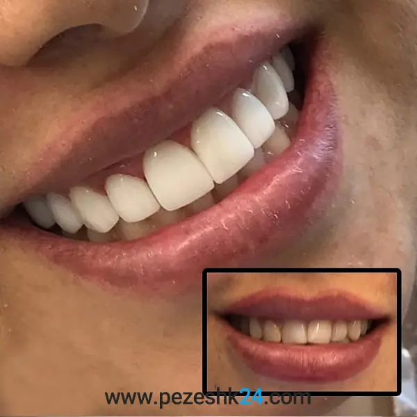 عکس قبل و بعد کامپوزیت دندان دکتر صدقی 4