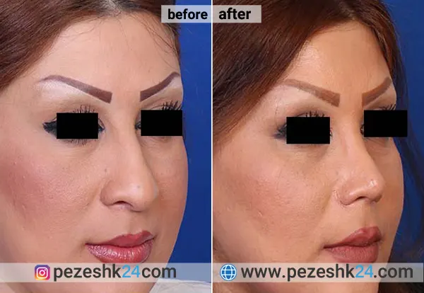 نمونه جراحی بینی دکتر آصفی 3