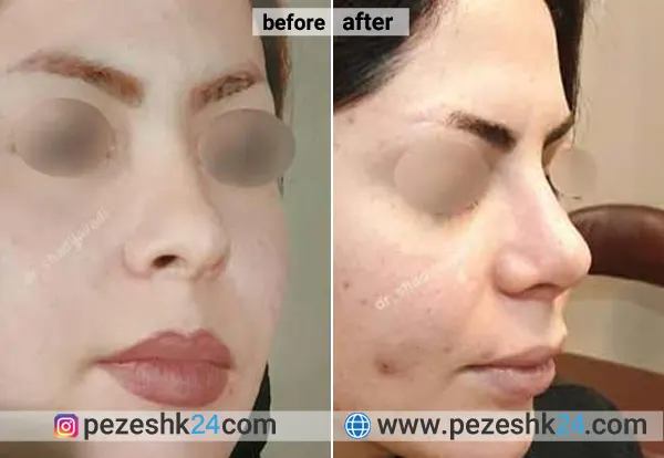 نمونه جراحی بینی دکتر جوادی 1