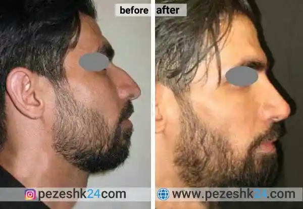 قبل و بعد جراحی بینی آقایان در مشهد 