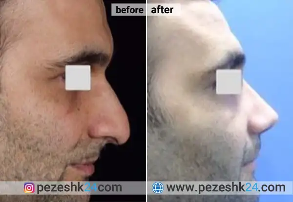 قبل و بعد جراحی بینی دکتر پیمان گهرشناسان در تهران 
