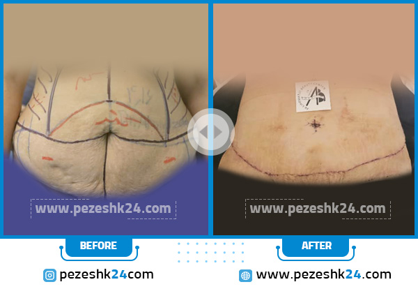 نمونه قبل وبعد بهترین جراح پیکرتراشی دکتر مجتبی احمدزاده در اصفهان