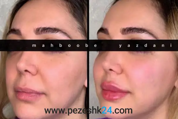 بهترین جراح کاشت گونه در رشت