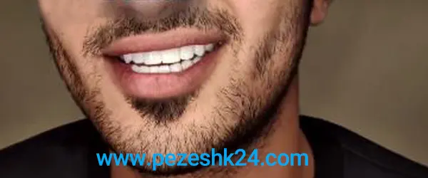 لمینت سرامیکی دندان های جلو آقایان