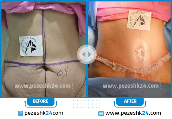 نمونه قبل و بعد پیکرتراشی دکتر مجتبی احمدزاده در اصفهان