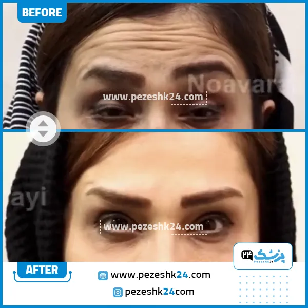 عکس قبل و بعد تزریق بوتاکس در نوآوران زیبایی مشهد