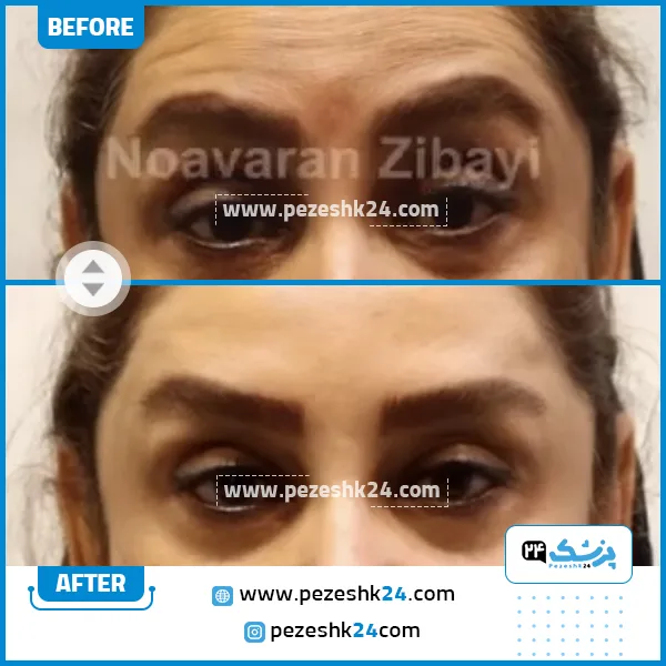 عکس قبل و بعد بوتاکس در کلینیک نوآوران زیبایی مشهد