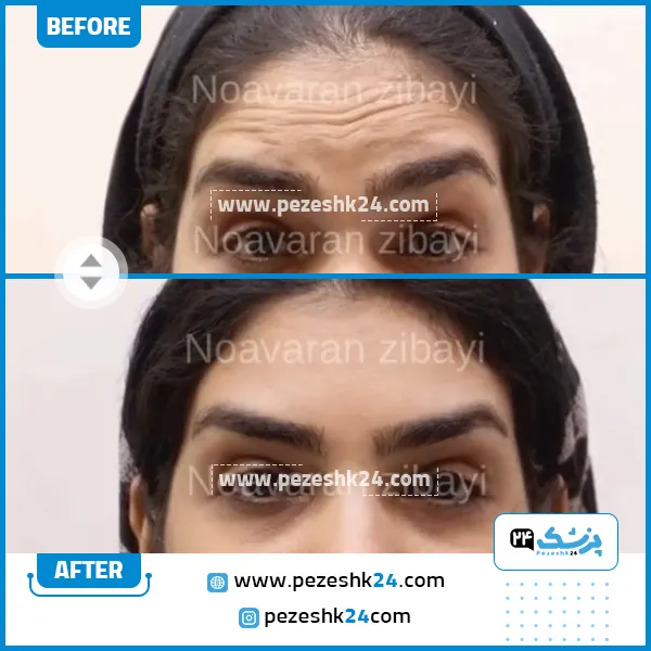 عکس قبل و یعد تزریق بوتاکس در کلینیک نوآوران زیبایی مشهد