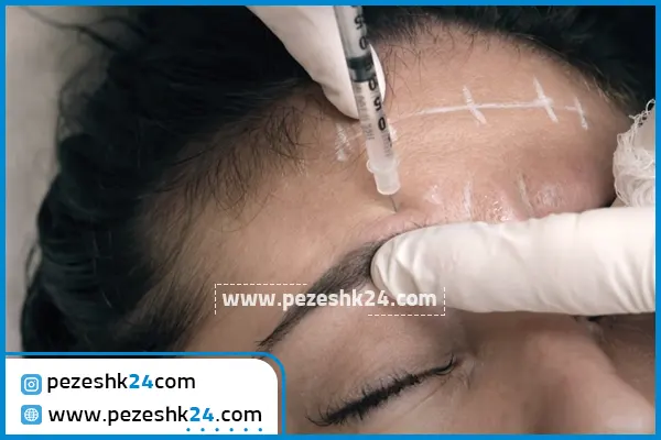 بوتاکس پیشانی در شیراز