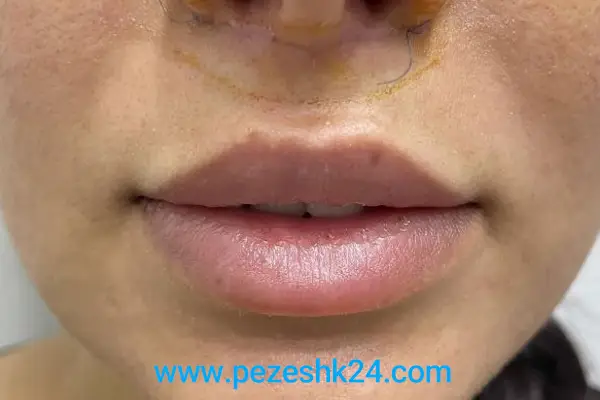 نمونه لیفت سانترال لب در اصفهان