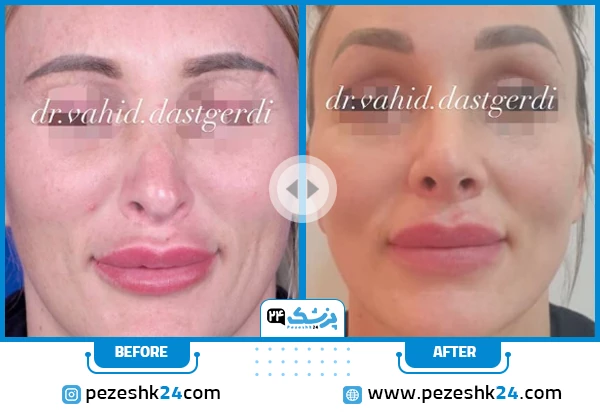 قبل و بعد لیفت صورت دکتر دستگردی