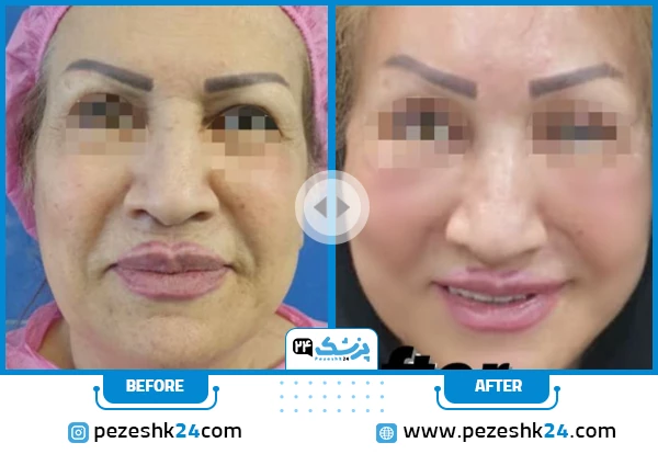 قبل و بعد لیفت صورت دکتر دستگردی شیراز