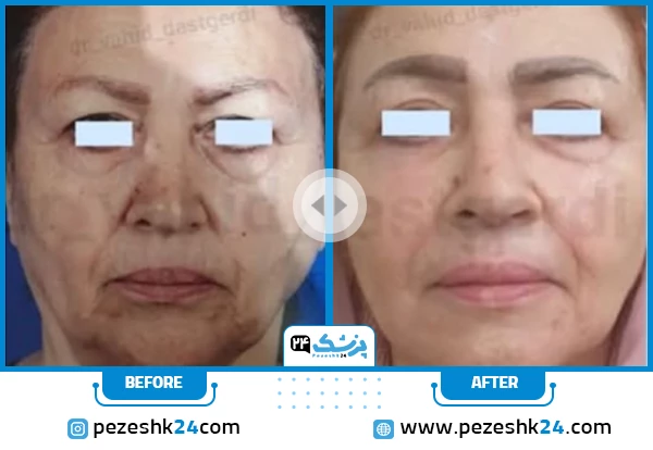 قبل و بعد جراحی لیفت صورت دکتر دستگردی شیراز