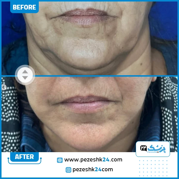 قبل و بعد لیفت صورت دکتر حقیقی فرد