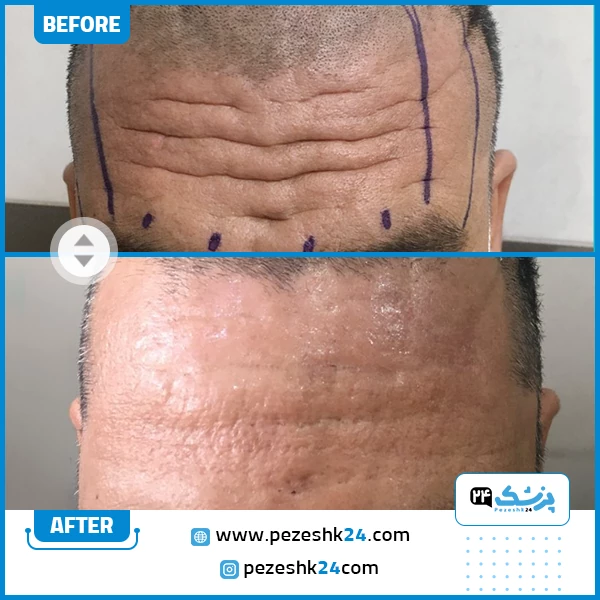 قبل و بعد لیفت صورت دکتر حقیقی فرد شیراز