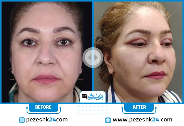 قبل و بعد لیفت صورت دکتر کبیری