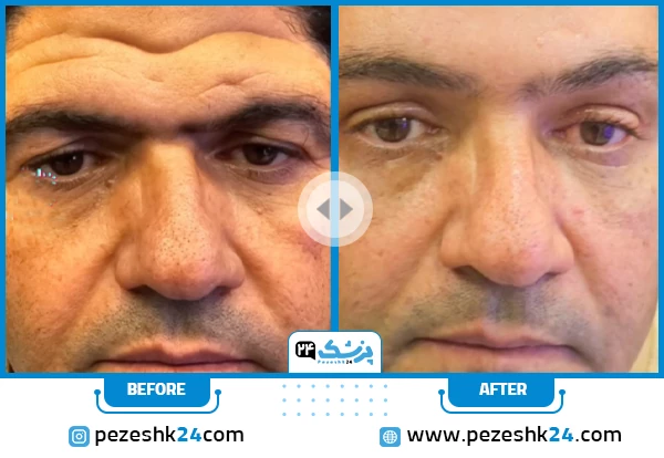 قبل و بعد لیفت صورت دکتر مهرابی